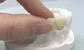 缺一顆牙的危害有多大?武漢仁愛口腔種牙靠譜嗎?貴嗎?缺1顆連累全口!有了它,60歲大叔生活重放光彩!