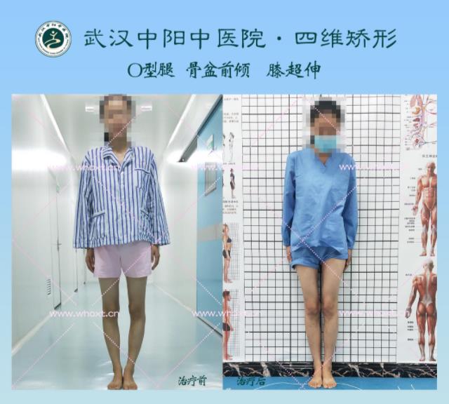 綁腿可以矯正O型腿嗎?武漢中陽(yáng)醫(yī)院四維矯形技術(shù)七天矯正腿型異常