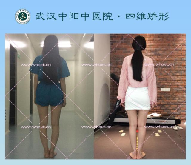 綁腿可以矯正O型腿嗎?武漢中陽(yáng)醫(yī)院四維矯形技術(shù)七天矯正腿型異常