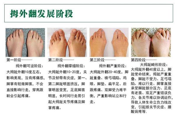 上海健橋拇外翻王慶成:拇外翻不治療會越來越嚴重嗎
