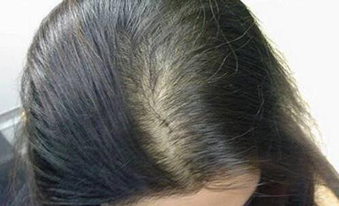 親身經歷分享:折磨我4年的產后脫發,被穴位生發方治愈