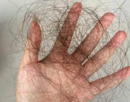 親身經歷分享:折磨我4年的產后脫發,被穴位生發方治愈