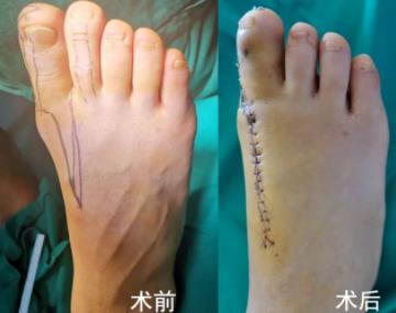 順德和平醫院靠譜嗎?廣西吉他手 順德再造斷指