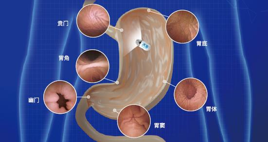 呼和浩特市東大肛腸醫院 胃鏡檢查很痛苦?五個胃鏡認識誤區你別“踩”