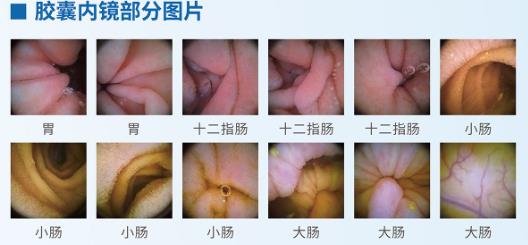 呼和浩特市東大肛腸醫院 胃鏡檢查很痛苦?五個胃鏡認識誤區你別“踩”