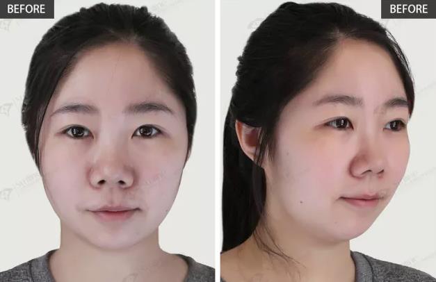 沈陽杏林整形外科醫院:國產玻尿酸和進口玻尿酸哪個好?