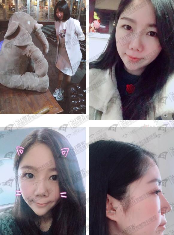 沈陽杏林整形外科醫院:國產玻尿酸和進口玻尿酸哪個好?