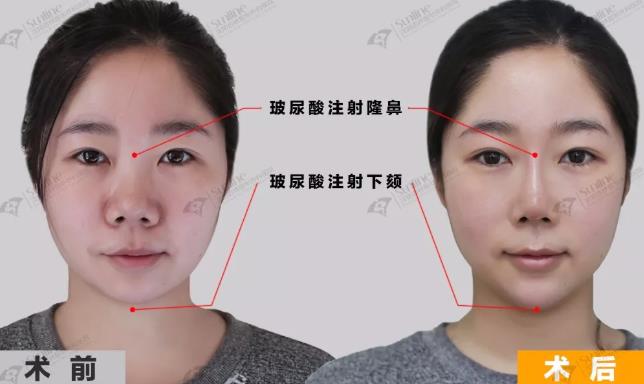 沈陽杏林整形外科醫院:國產玻尿酸和進口玻尿酸哪個好?