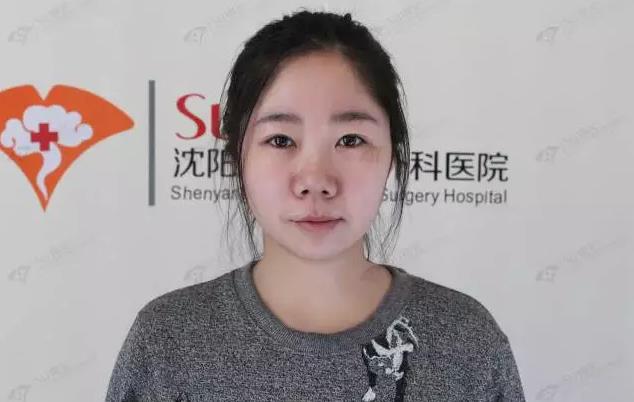 沈陽杏林整形外科醫院:國產玻尿酸和進口玻尿酸哪個好?