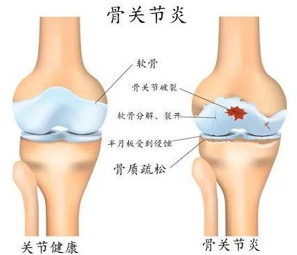 重慶哪個骨科醫(yī)院好-重慶看關(guān)節(jié)炎哪里好?重慶紅樓醫(yī)院