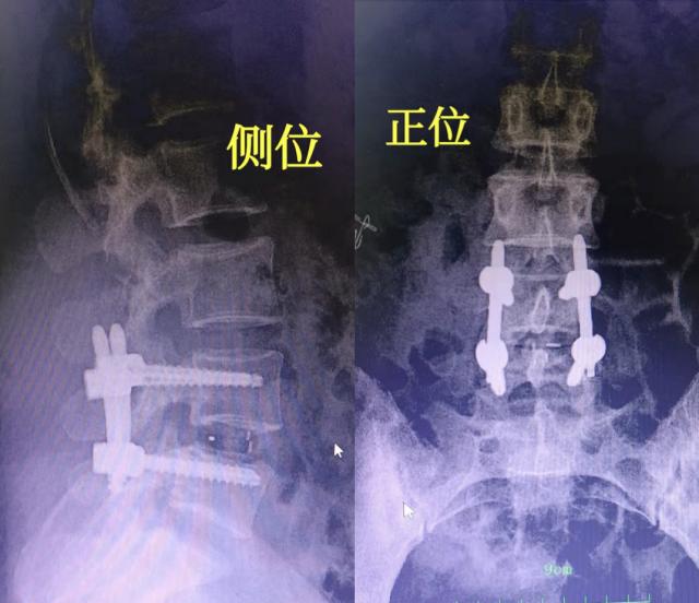 中山源田骨科醫(yī)院警告:兒童述腰痛,家長應(yīng)重視 --腰痛的微創(chuàng)治療 image.png