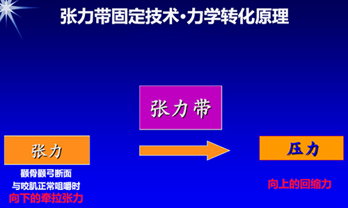 聯合麗格何照華教授:顴骨顴弓術后只能用鈦板鈦釘固定嗎? 1H33TD7-5.png