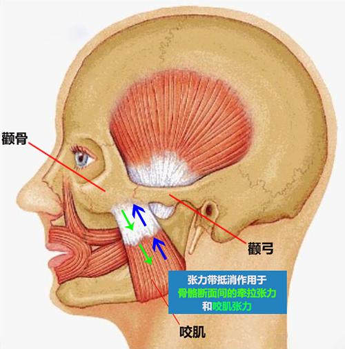 聯合麗格何照華教授:顴骨顴弓術后只能用鈦板鈦釘固定嗎? 1H33R331-6.png