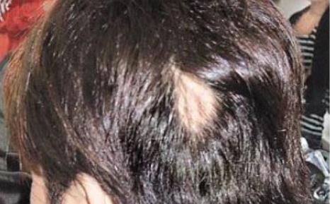 熬夜玩手機美女差點變禿頭 斑禿是怎么引起的