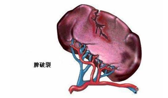 外賣(mài)小哥脾臟被摘除 導(dǎo)致脾破裂的原因