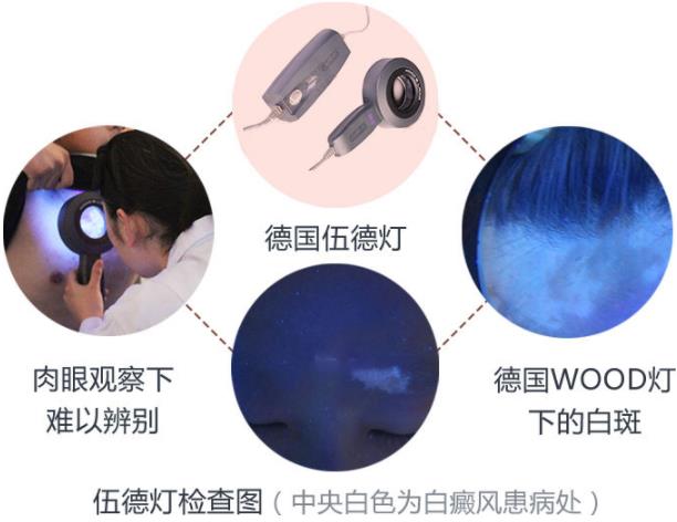 南通白癲風醫院【名醫會診公告】上海名醫秦立模會診南通復大