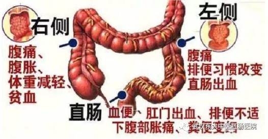 武漢東大肛腸醫院:記得重視腸道檢查