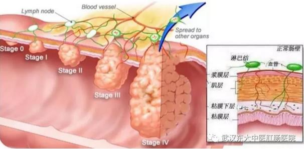 武漢東大肛腸醫院:記得重視腸道檢查