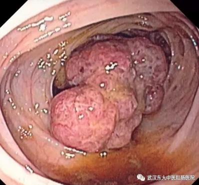 武漢東大肛腸醫院:記得重視腸道檢查