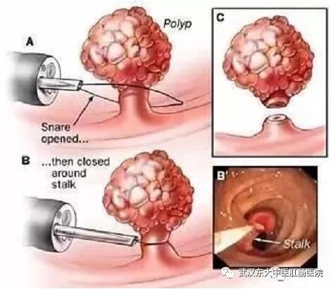 武漢東大肛腸醫院:記得重視腸道檢查