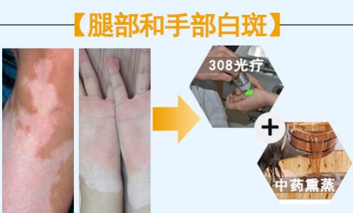 華研白癜風醫院的308激光治療效果怎么樣?前端技術,值得相信