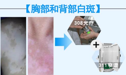 華研白癜風醫院的308激光治療效果怎么樣?前端技術,值得相信