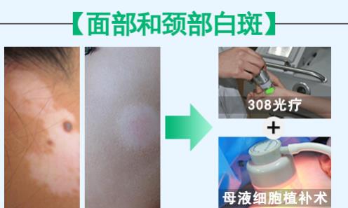 華研白癜風醫院的308激光治療效果怎么樣?前端技術,值得相信