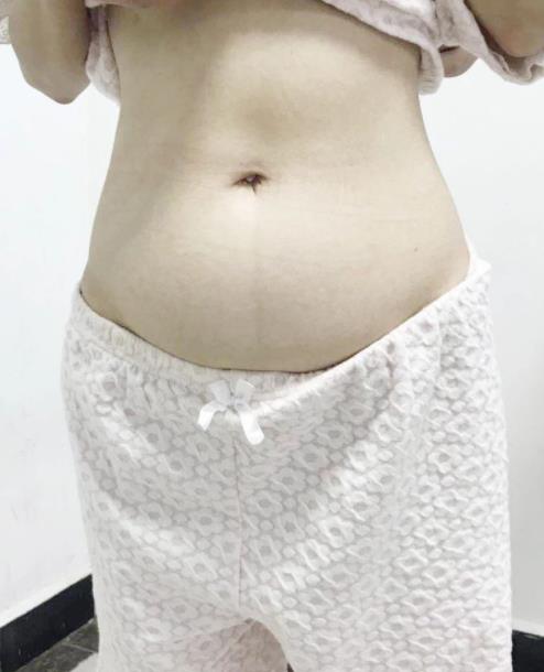 “拆彈”籃球大腫瘤,出血量僅2毫升,北京愛康醫療集團j精準治療獲患者點贊