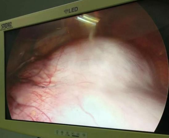“拆彈”籃球大腫瘤,出血量僅2毫升,北京愛康醫療集團j精準治療獲患者點贊