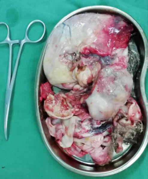 “拆彈”籃球大腫瘤,出血量僅2毫升,北京愛康醫療集團j精準治療獲患者點贊