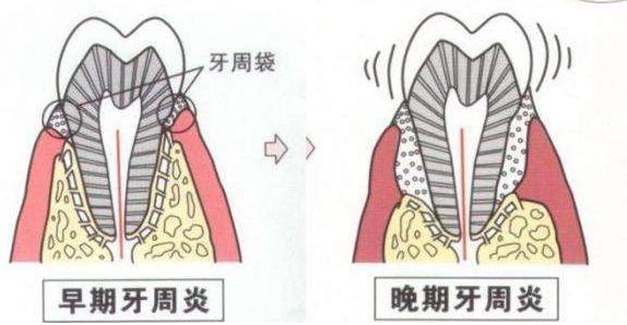 牙疼也分好幾種,專業牙醫教你如何快速正確緩解!