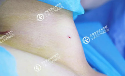 濟南顯微外科醫院治療甲狀腺怎么樣?微創治療專業醫院 11-5-6-500.jpg
