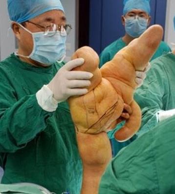 世界上最大的手指 他食指長達30厘米(整個手臂重20斤)