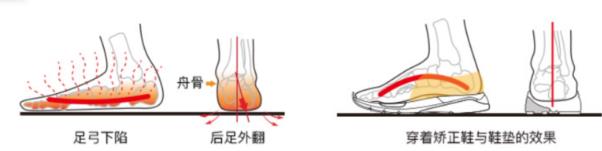 足外翻要重視,穿矯正鞋進行科學干預
