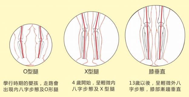 想要孩子擁有筆直長腿,家長應(yīng)及時給孩子定制矯正鞋干預(yù)