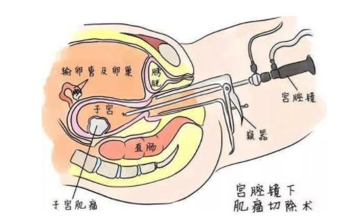 宮腔鏡檢查大概多少錢 宮腔鏡檢查的4大注意事項
