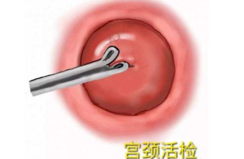 宮頸活檢費用是多少 宮頸活檢的注意事項