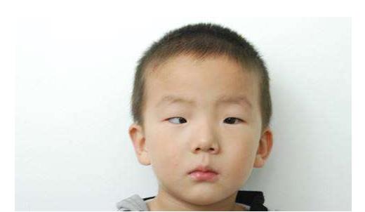 兒童斜視是什么 如何預防兒童斜視