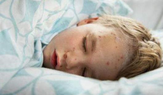 猩紅熱的癥狀是什么?猩紅熱的飲食禁忌