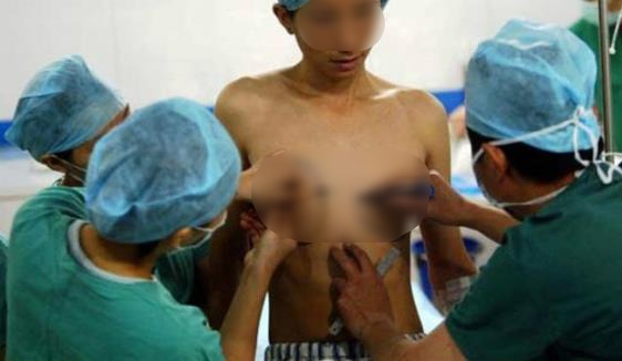 泰國人妖手術