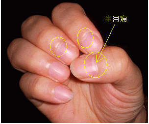 指甲上的半月痕你懂多少？指甲半月痕與健康吉兇