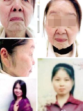 85年少婦分娩后變老太，獲得性面部皮膚衰老癥怪病無藥可醫，早婚早育生第二胎