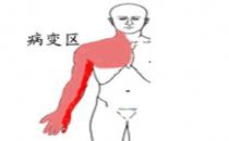  什么是胸廓出口綜合征？