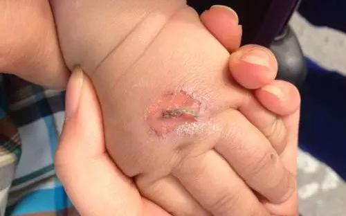 孩子常見的意外損傷類型有哪些？
