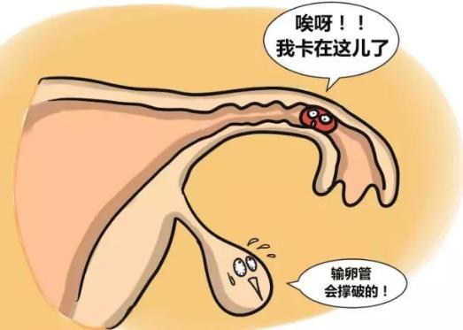 輸卵管妊娠的自我檢查、癥狀及治療方法