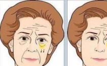 北京彤美整形醫(yī)院劉風卓眼整形怎么樣