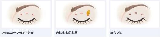 北京彤美整形醫(yī)院劉風卓：雙眼皮手術(shù)恢復需要多久