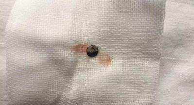 普瑞眼科取出患者眼內5毫米金屬，保住眼球