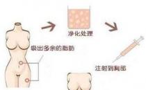 煤醫(yī)整形：自體脂肪豐胸的四大優(yōu)勢(shì)