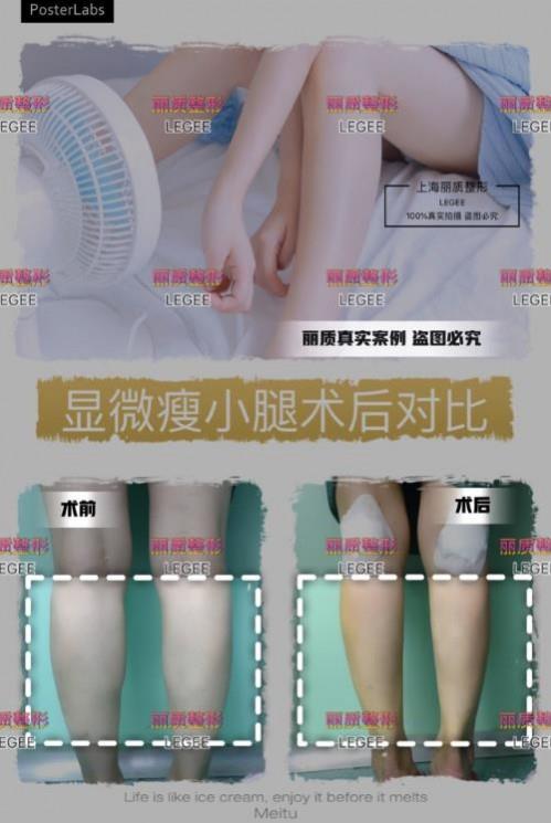 上海麗質美學整形門診部做瘦小腿價格貴嗎？肌肉小腿太難減怎么辦